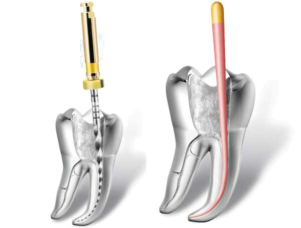 endodoncja